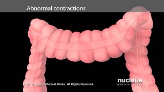 Irritable Bowel Syndrome IBS [upl. by Claudina70]