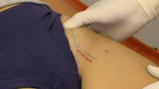 Injection for psoas bursitis [upl. by Hartzel]