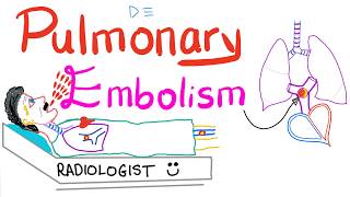 Pulmonary Embolism PE [upl. by Neillij]