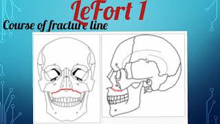 FRACTURES OF MIDDLE THIRD OF FACE PART 1 [upl. by Agnes]