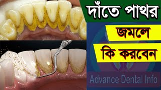 দাঁতের পাথর দূর করার উপায়  Date Pathor Dur Korar Upay  Teeth Stone Removal At Home In Bangla [upl. by Nolava]