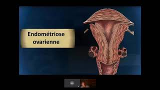 LENDOMETRIOSE  WEBINAR ECHOGRAPHIE GYNECOLOGIQUE [upl. by Heller]