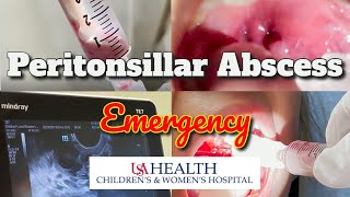 Peritonsillar Abscess Emergency and Needle Aspiration [upl. by Rovner]