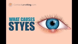 What Are Styes Causes Symptoms and Treatments [upl. by Znarf789]