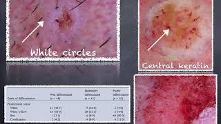 Lip Squamous Cell Carcinoma  Dr Caterina Longo [upl. by Assenat]