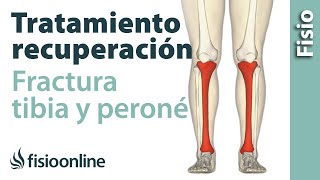 FRACTURA de TIBIA y PERONÉ Rehabilitación ejercicios y tiempo de recuperación [upl. by Egduj]