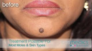 Mole Removal Surgery for Best Results at London amp Bristol Clinics [upl. by Mikah]