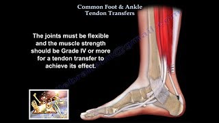 Common Foot amp Ankle Tendon Transfers  Everything You Need To Know  Dr Nabil Ebraheim [upl. by Kristoffer]