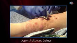 WCW Abscess Incision and Drainage [upl. by Adiuqram]