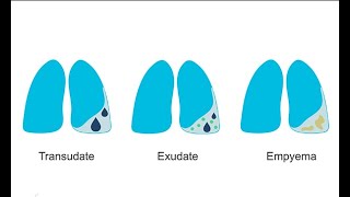 How to recognize different pleural effusions on chest CT [upl. by Amikay728]