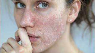 HARD WATER AND YOUR SKIN HOW TO DEAL WITH IT DR DRAY [upl. by Birch]