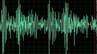 Aortic Regurgitation  Heart Sounds  MEDZCOOL [upl. by Etnud]