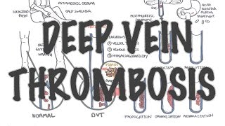 Deep Vein Thrombosis  Overview pathophysiology treatment complications [upl. by Adekahs]