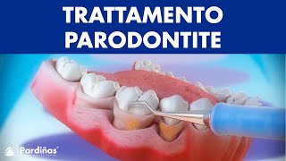 Trattamento parodontite – Curettage e sondaggio parodontale © [upl. by Sidnac]