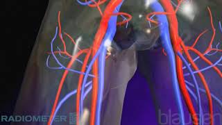 Pulmonary Embolism [upl. by Shantha]