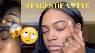 STAGES OF A STYE  CURE 👁 [upl. by Kared]