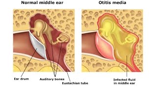 Otitis Media [upl. by Lotte]