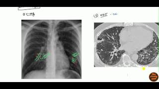 Bronchiectasis for USMLE [upl. by Eresed]