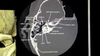 Facial Nerve Segments [upl. by Nodroj]