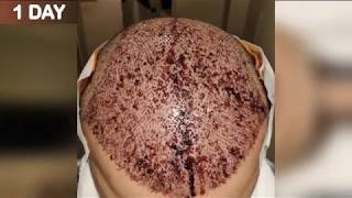 FUE Hair Transplant Timeline I Day 1 to Day 365 [upl. by Anilorak330]