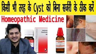 Cyst  Homeopathic Medicine for All type of Cyst  Remove 100 [upl. by Sualokcin236]