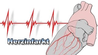 Herzinfarkt  Krankheiten des Herzens  Pflege Kanal [upl. by Betteann311]