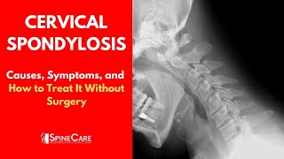 CERVICAL SPONDYLOSIS Causes Symptoms and Treatment NO SURGERY [upl. by Aetnuahs978]