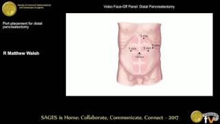 Distal Pancreatectomy Explained Dr Pejman Radkani [upl. by Anairad72]