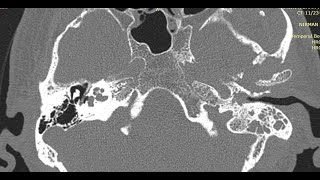 How to Read HRCT Temporal Bone  All Basics in Detail [upl. by Aurita923]