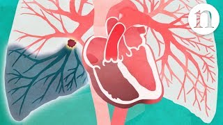 Pulmonary embolism The route to recovery [upl. by Annwahs]