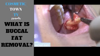 Buccal Fat Cheek Fat Removal Most Common Questions [upl. by Llemart309]