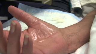 Trigger Finger Injection Therapy [upl. by Remliw]