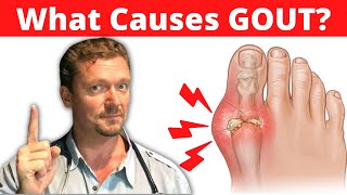 What Causes GOUT Meat Doesnt Cause Gout 2024 [upl. by Allit276]