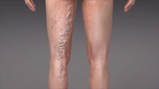 Venous Insufficiency Varicose Veins [upl. by Celka]