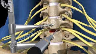 Anterior Cervical Fusion C6 C7 [upl. by Cire]