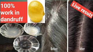 how to remove dandruff in one wash how to get rid of dandruff in one washscalp dandruff removal [upl. by Assel876]