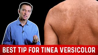 Natural Skin Fungus Tinea Versicolor Home Remedies – Dr Berg [upl. by Savina]