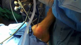 Ankle Arthroscopy [upl. by Airitac242]