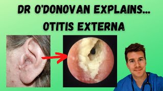 Explaining Otitis Externa  With Dr ODonovan [upl. by Cressler]