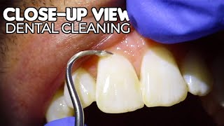 Dental Cleaning  CloseUp View ASMR [upl. by Grosvenor437]