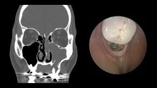 Odontogenic Sinusitis Sinus Surgery First [upl. by Assanav381]