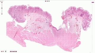 Peptic Ulcer  Histopathology [upl. by Sheehan670]