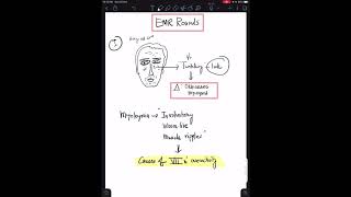 Case 4 Orbicularis Myokymia  Facial Nerve Overactivity [upl. by Nerot]