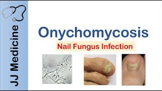 Onychomycosis  Nail Infection  Signs Symptoms Treatment [upl. by Lebama659]