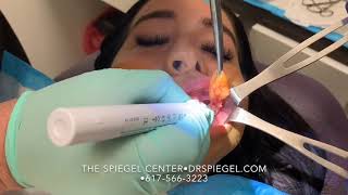 Buccal Fat Removal at The Spiegel Center [upl. by Almeta]