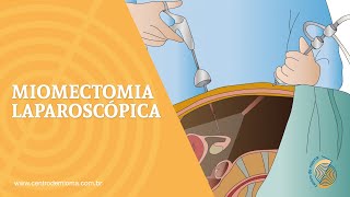 Miomectomia Laparoscópica  Vídeo 8 [upl. by Ilajna153]