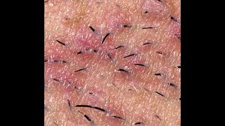 Removing Ingrown Hairs Hair  Eruptive Vellus Hair Cysts [upl. by Eelarual]