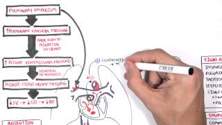 Pulmonary Embolism PART I Overview [upl. by Bez]