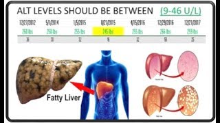 How I lowered my ALT level alanine aminotransferase liver levels [upl. by Iand]