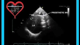 Severely Dilated Left Atrium [upl. by Arias632]